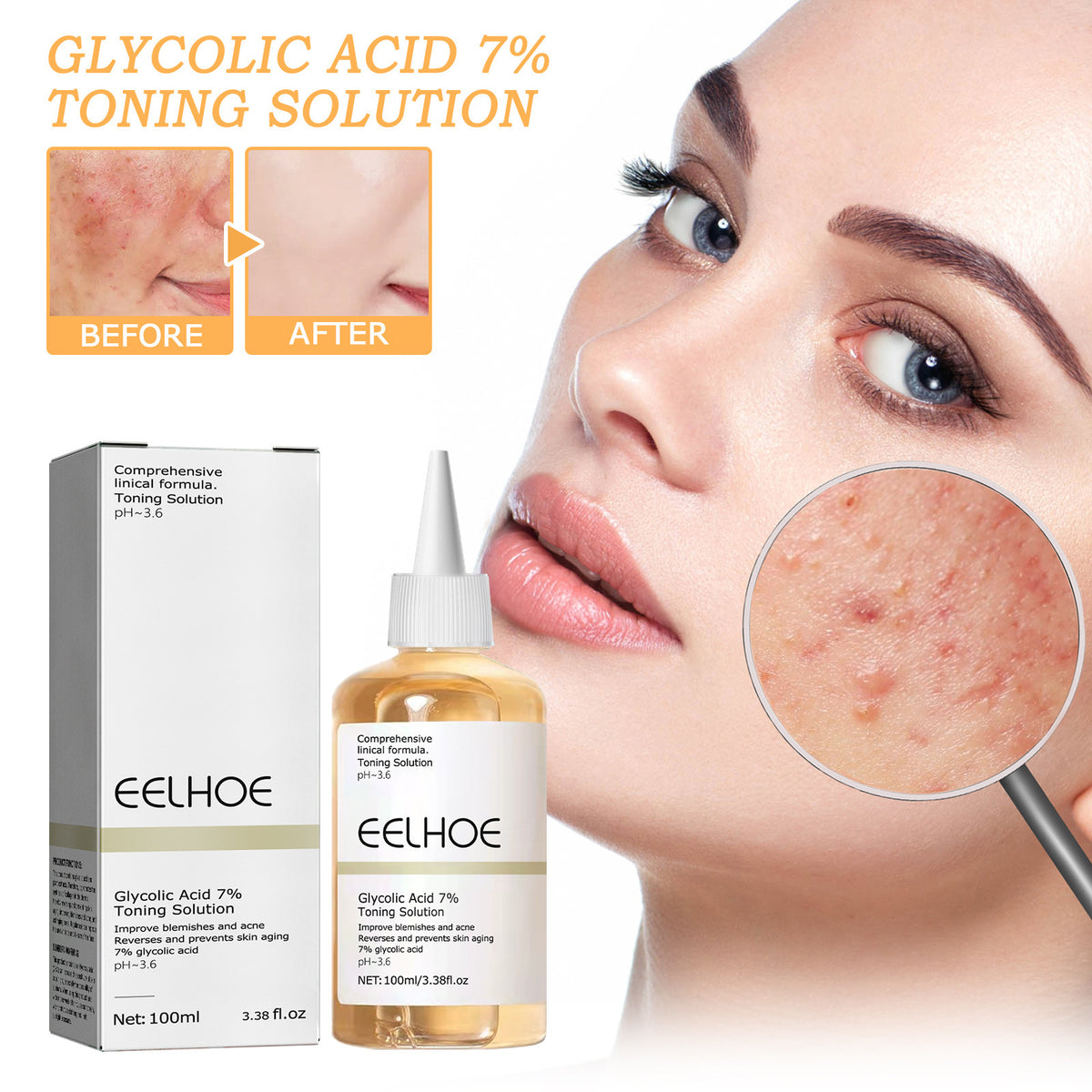 EELHOE Glycolic Acid 7 Lotion Acne Removing Closed Mouth
